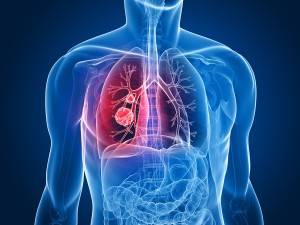 Asbestos-Related Lung Cancer Diagnosed