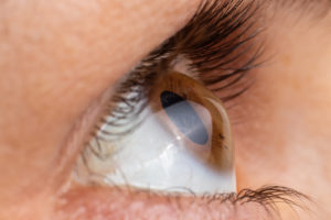 Elmiron Eye Damage Lawsuit