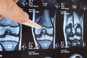 Knee Implant failure