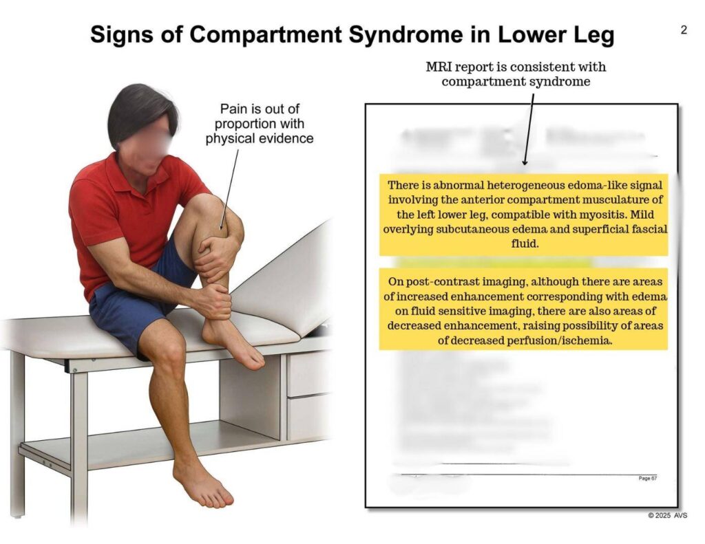 Sign of Compartment SUndrome in Lower Leg