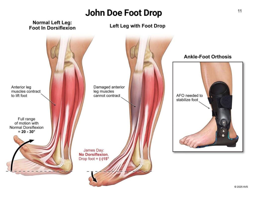 John Doe Foot drop