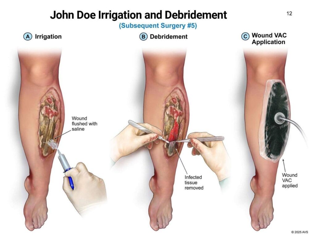 Irrigation and Debridemenr