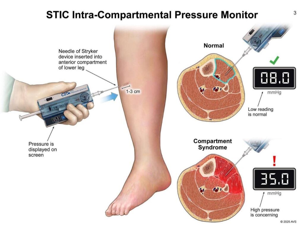 StIC Intra Compartmental Pressure Monitor