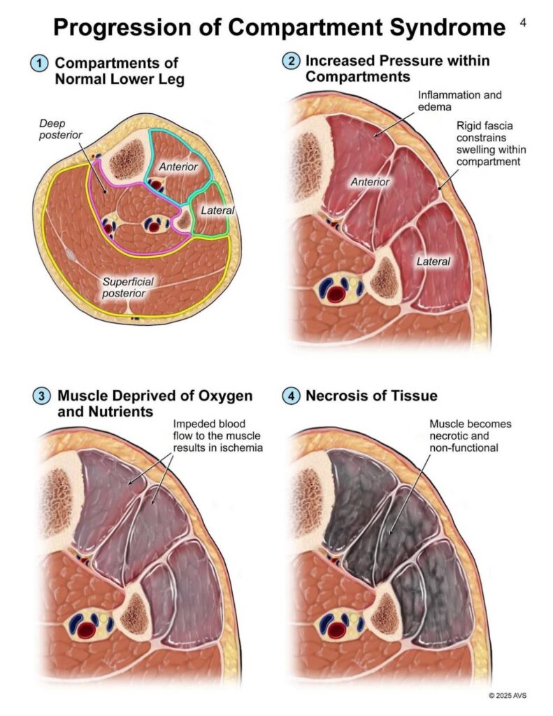 Progression of Compartment Syndrome