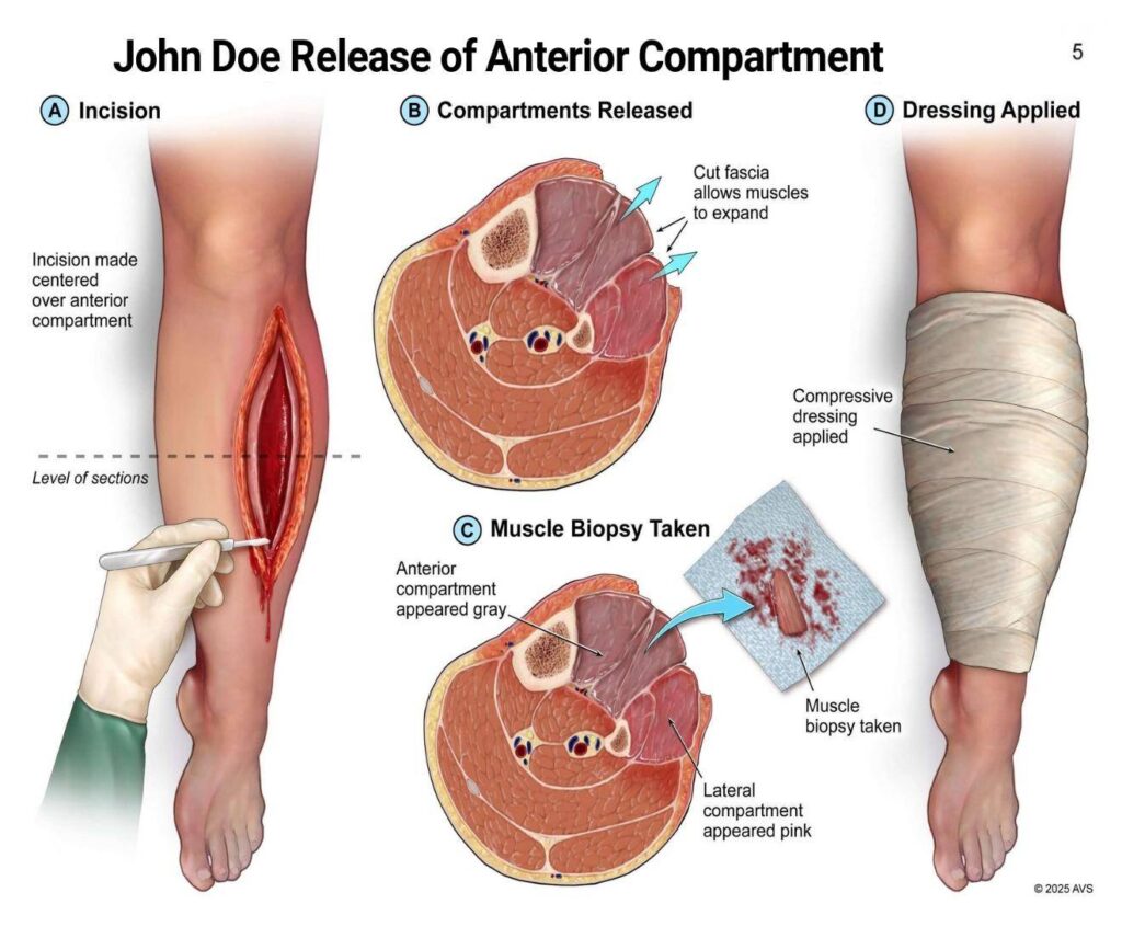 John Doe Release Of Anterior Compartment
