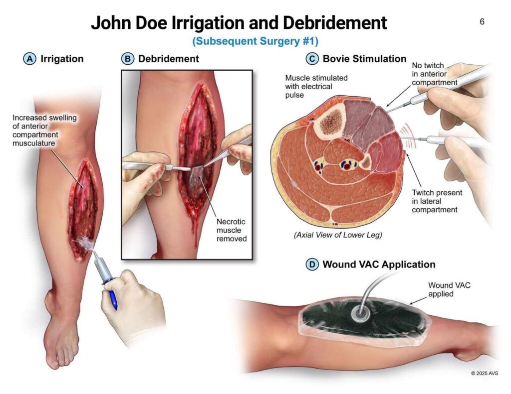 John Doe Irrigation and Debridement