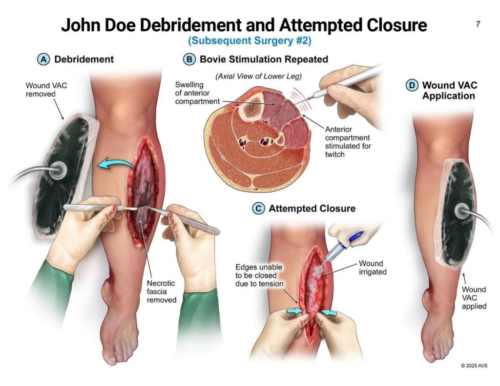 John Doe Debridement and Attempted Closure