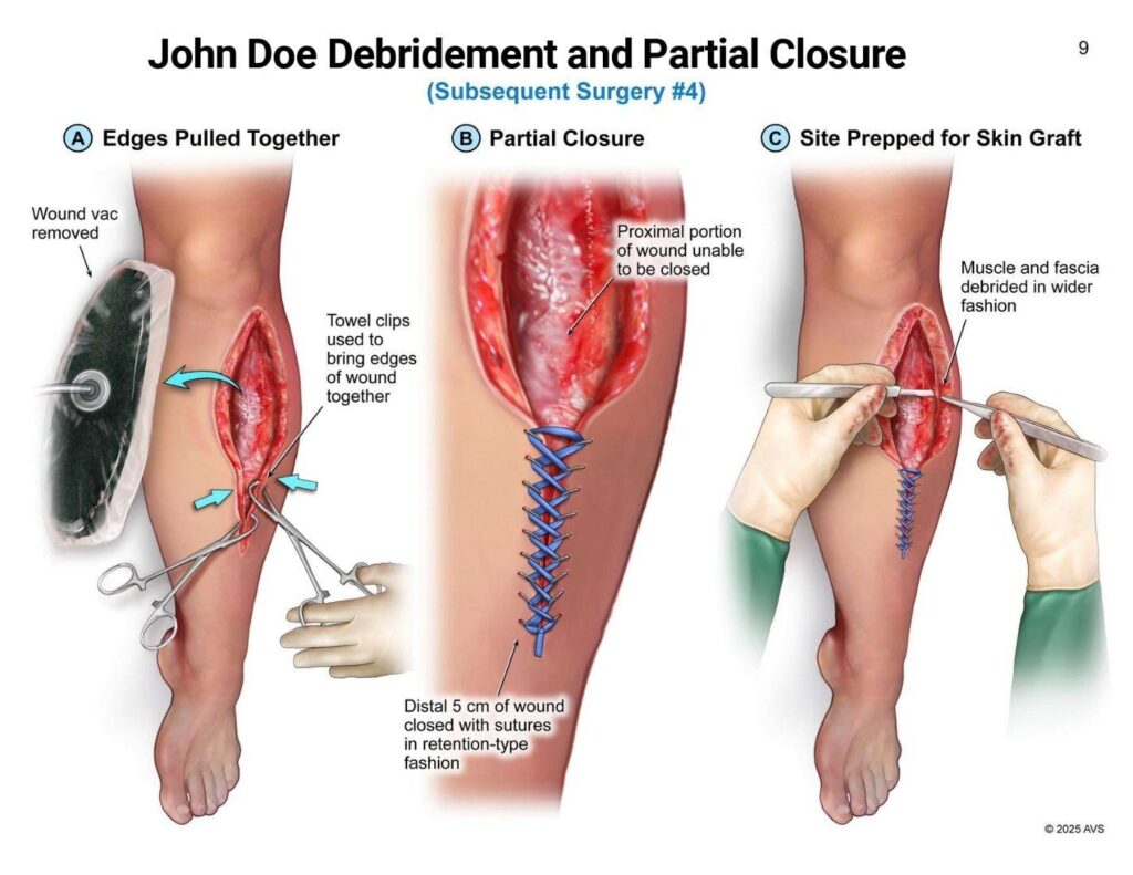John Doe Debridement and Partial Closure