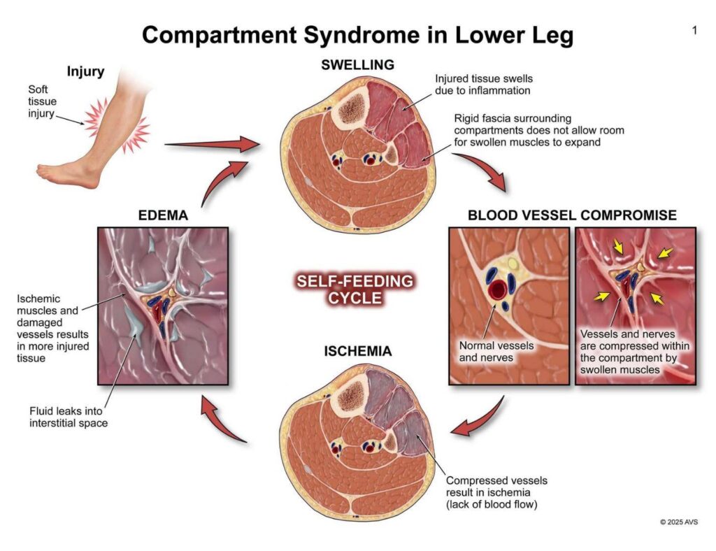 Compartment Syndrome in Lower Leg