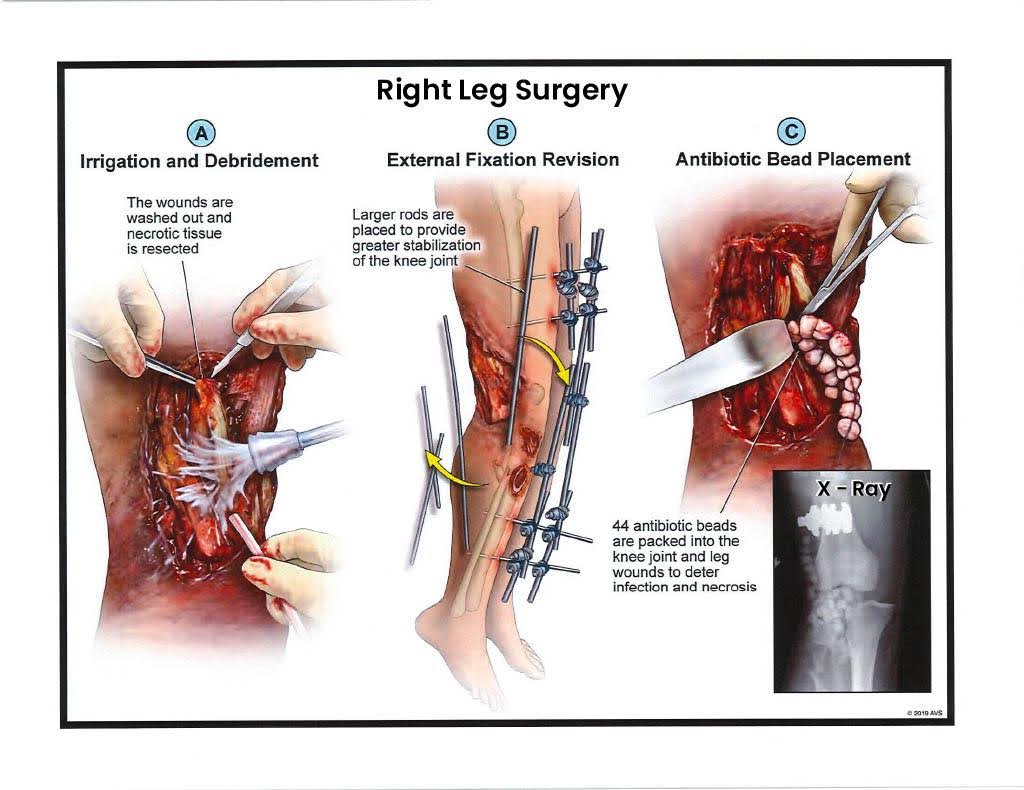 Exhibit E — Right Leg Surgery – External Fixation Revision