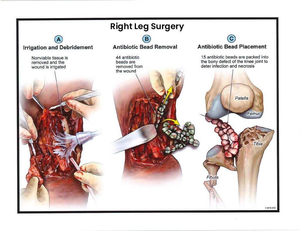 Exhibit F — Right Leg Surgery – Bead Removal