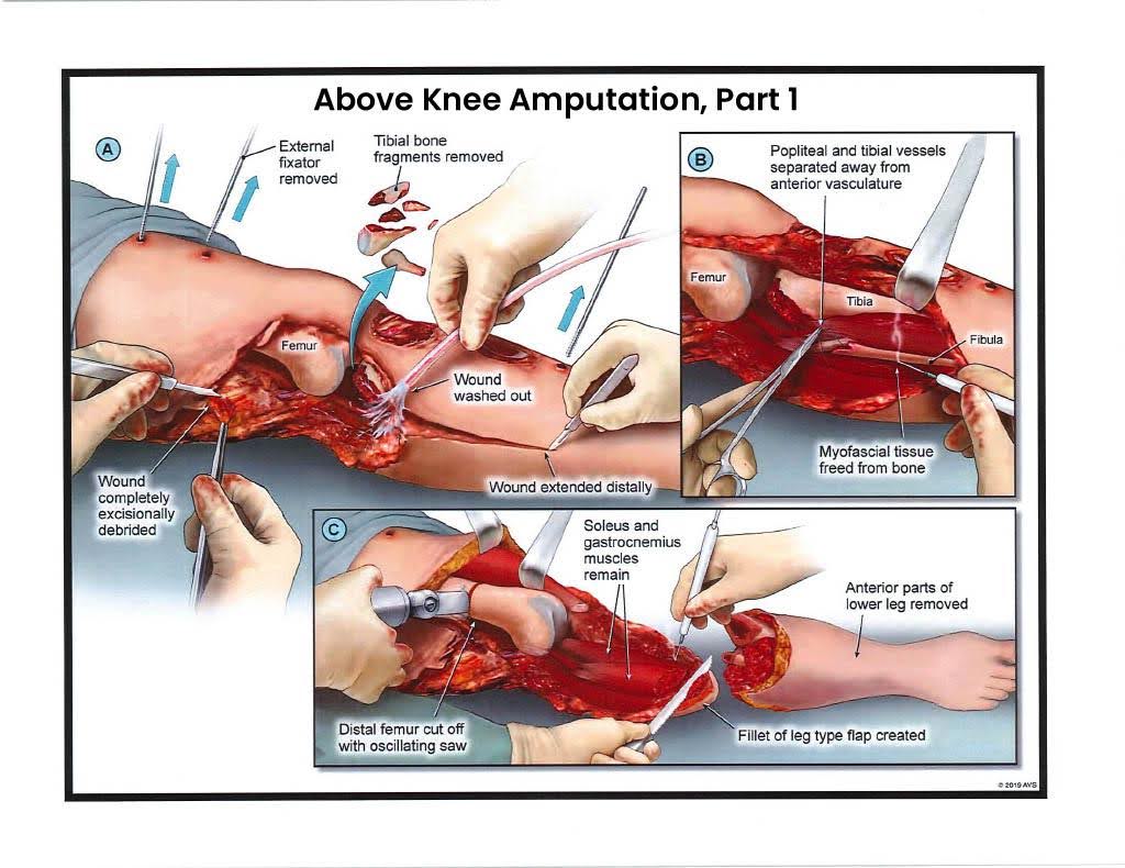 Exhibit G — Above Knee Amputation – Part 1 