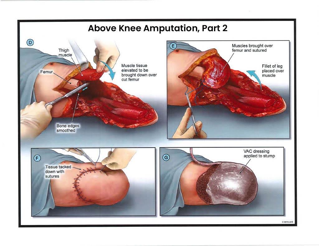 Exhibit H — Above Knee Amputation – Part 2