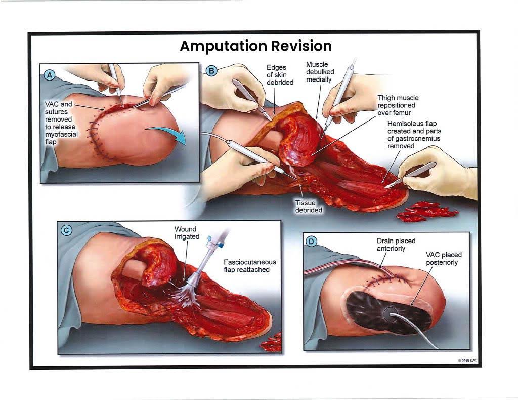 Exhibit I — Amputation Revision – Stage 1