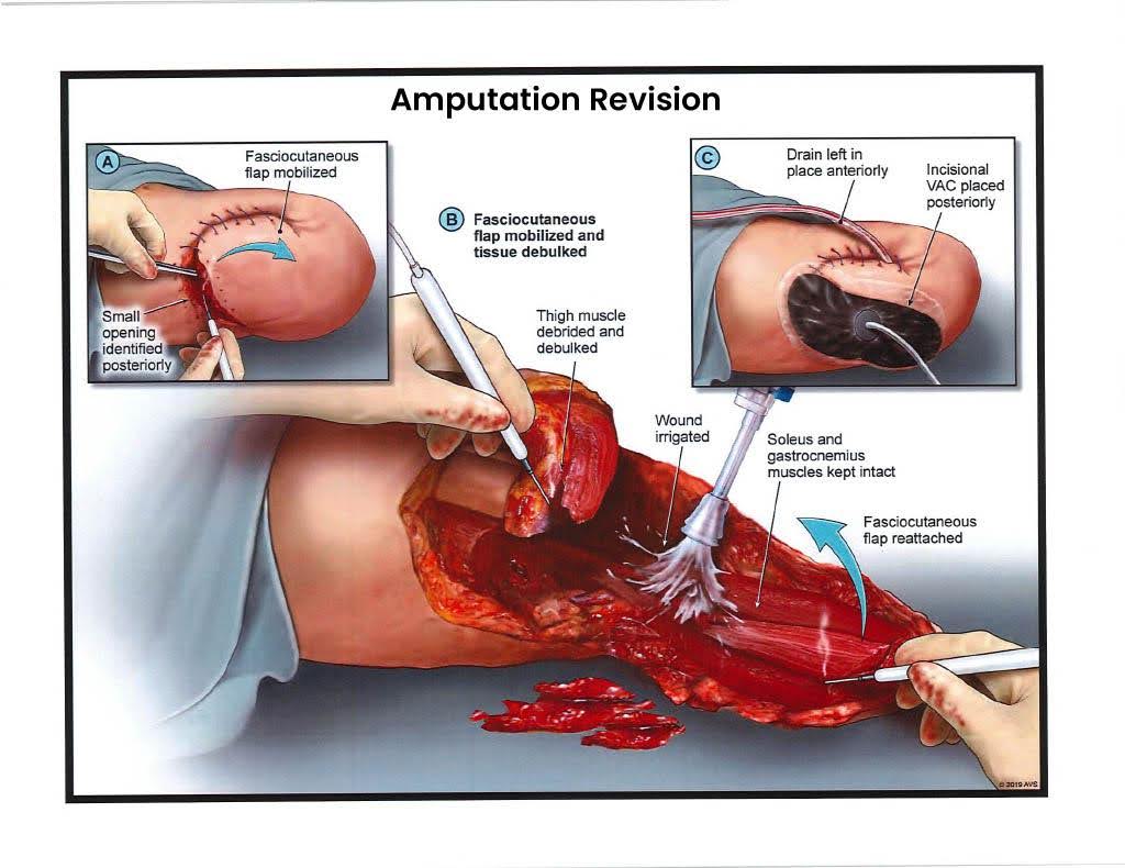 Exhibit J — Amputation Revision – Stage 2