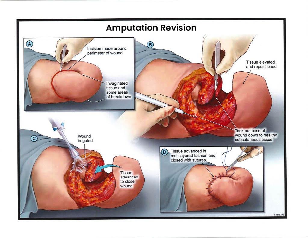 Exhibit K — Amputation Revision – Stage 3