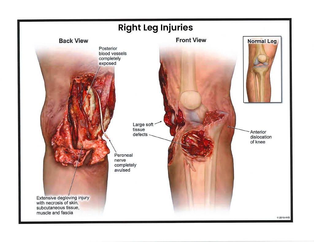 right-leg-injuries