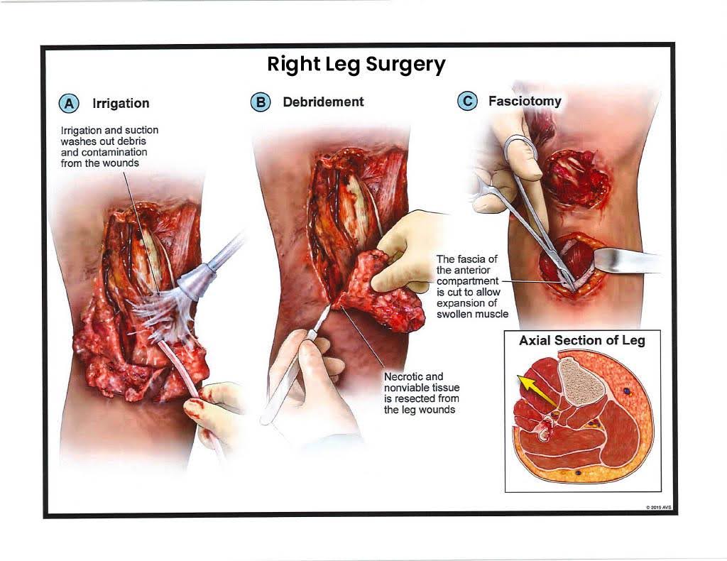 Right Leg Surgery – Debridement and Fasciotomy 